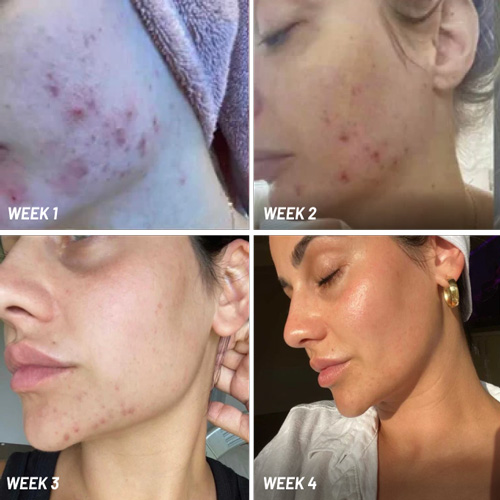 Person using Akemi Glow LED Light Therapy mask at home